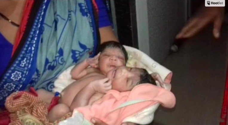 Mulher deu à luz meninas gêmeas siameses na Índia (Foto: Reprodução: India Today/Mohammad Suffian)