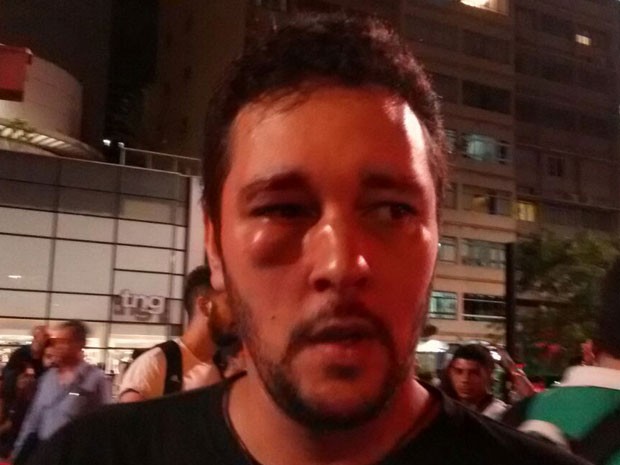 O designer Hélio de França Teixeira, de 33 anos, foi agredido com um soco no olho por um grupo de rapazes contrários à manifestação que ocorre na Avenida Paulista.  (Foto: Letícia Macedo/G1)