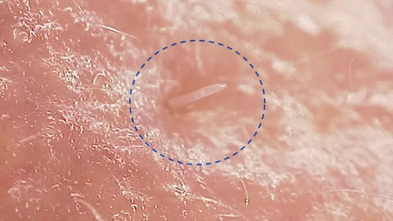 Os ácaros Demodex folliculorum, como os cientistas os chamam, têm apenas 0,3 mm de comprimento (Foto: University of Reading via BBC News)