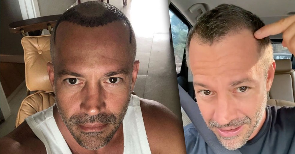 Malvino assim que fez o transplante e o resultado hoje  — Foto: Reprodução/Instagram
