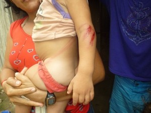 Criança teve diversos ferimentos pelo corpo (Foto: Walter Filho/TV Amazonas)
