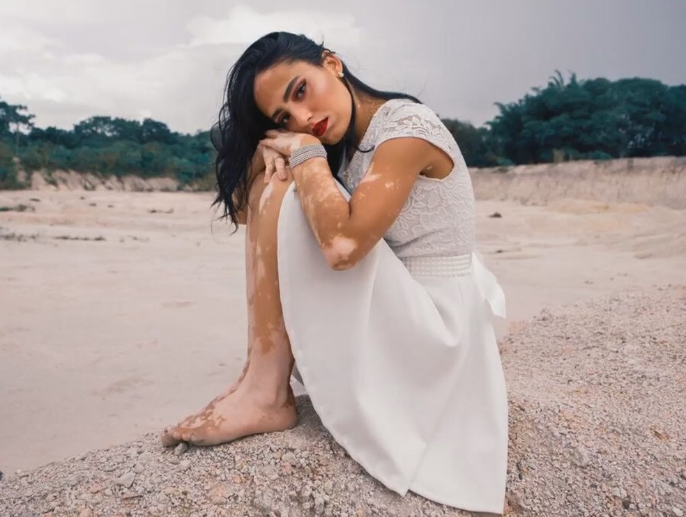 Larissa Sampaio, modelo brasiliense com vitiligo, em ensaio fotográfico — Foto: SouzaArt/Divulgação
