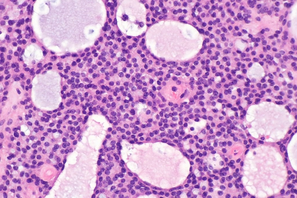 Micrografia mostrando tumor estromato microcístico do ovário (Foto: Nephron/Wikimedia Commons)