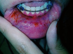 Soco acertou a boca da jovem (Foto: Arquivo pessoal/Miriam Alves)