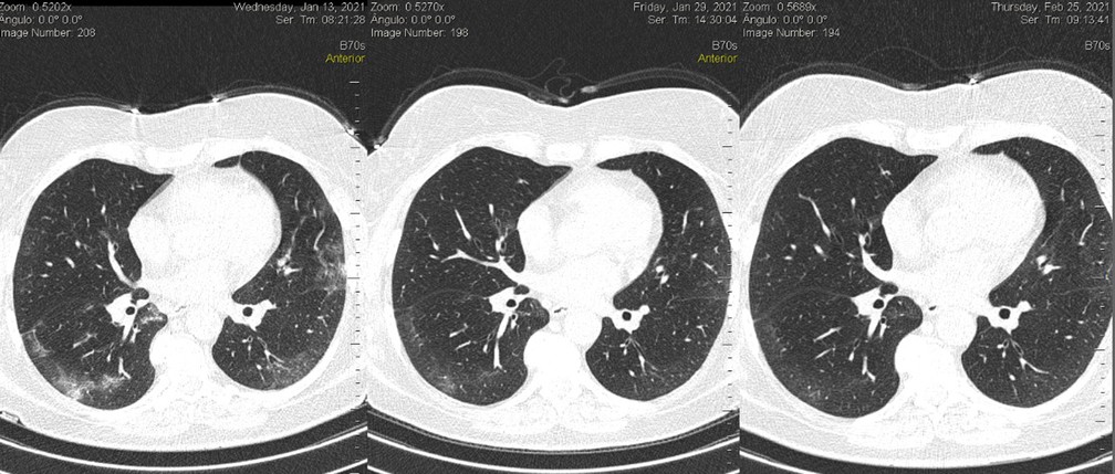 pulmão de paciente em três momentos; comprometido e com muitas manchas brancas e depois recuperado — Foto: Reprodução