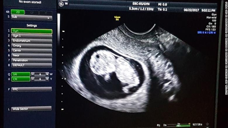 Ultrassonografia mostra bebê se desenvolvendo normalmente no útero transplantado.   (Foto: Hospital das Clínicas)