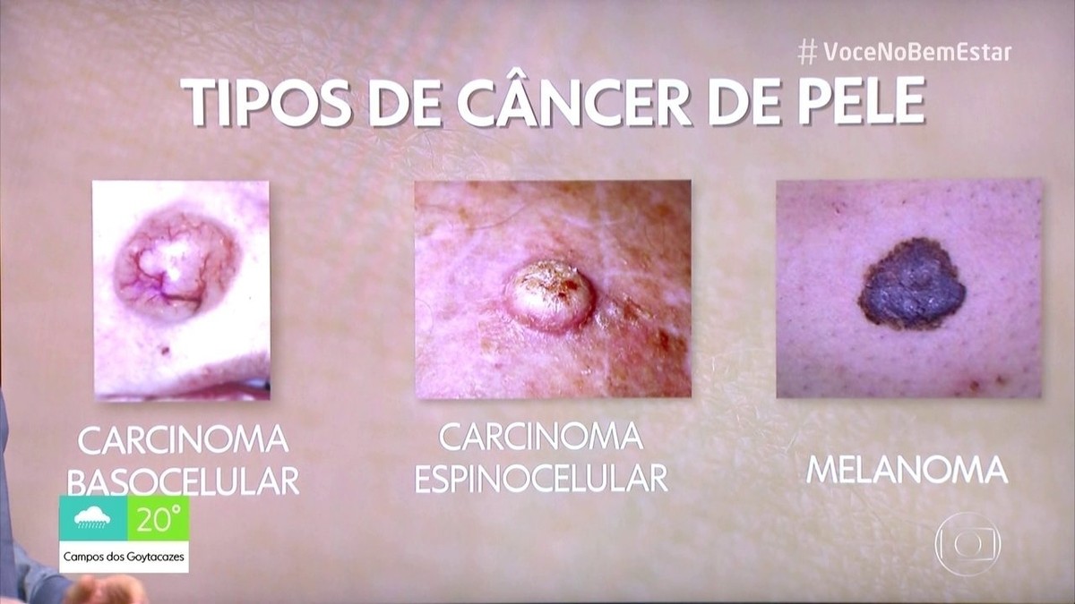 Entenda os tipos de câncer de pele | Bem Estar | G1