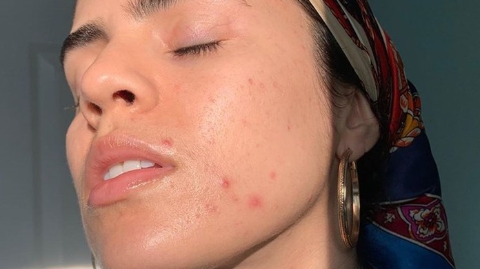 Sem espremer! Te ensinamos a tratar sua acne da maneira correta | Pele |  Glamour