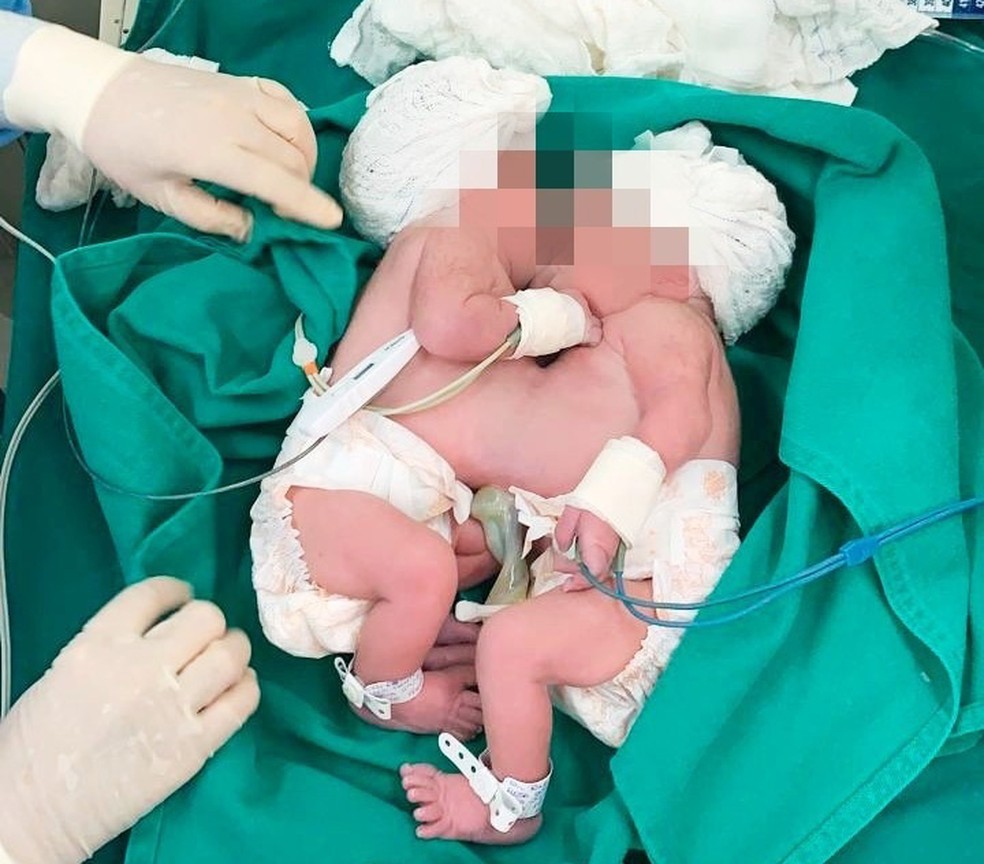 Jovem dá à luz a gêmeas siamesas — Foto: Sesab / Divulgação 