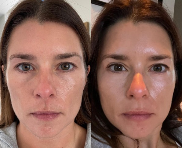 Danica Patrick mostra antes e depois de seu rosto apenas algumas horas após o procedimento de remoção dos implantes (Foto: Reprodução/Instagram)