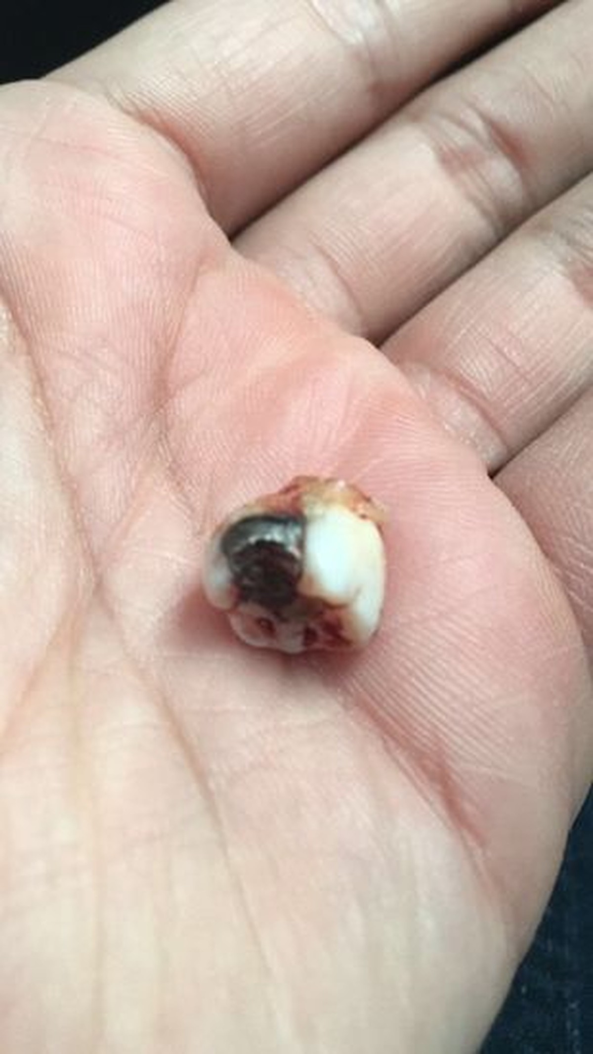 Dentista Explica Milagre De Dente Que Parou Tiro E Aponta O Heroi Um Siso Santos E Regiao G1