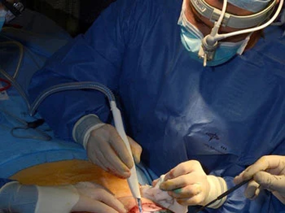 Imagem de um cirurgião usando o iKnife para identificar tecido cancerígeno em tempo real
