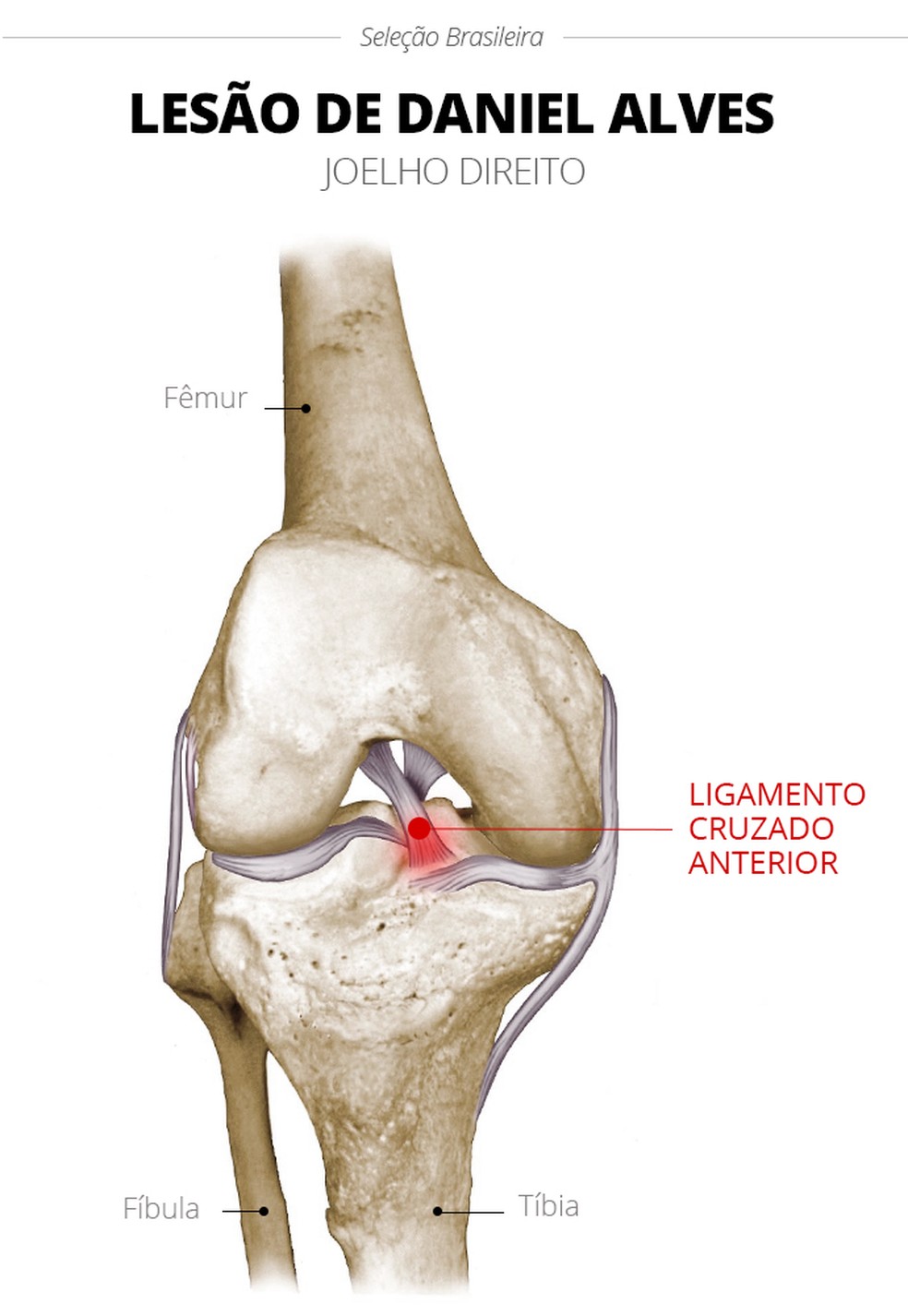 Lesão de Daniel Alves é no ligamento cruzado anterior (Foto: Infoesporte)