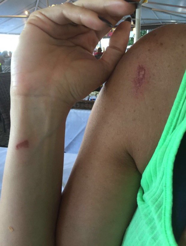 Cozete Gomes mostra machucados após desfile na Unidos da Tijuca (Foto: Divulgação)