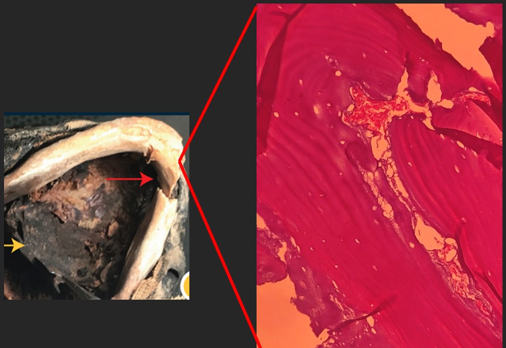 Vista da base da mandíbula com Fratura Obliqua (seta vermelha) e tecido do palato mole preservado (Foto: Eder Huttner, Bruno Candeias, Edison Huttner.)