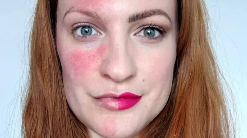 Lex Gillies, hoje com 37 anos, foi diagnosticada com rosácea aos 21 (Foto: LEX GILLIES/BBC)