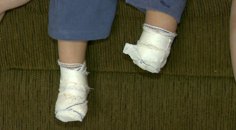 Miguel teve o p&eacute; esquerdo amputado ap&oacute;s ser internado com pneumonia na Santa Casa de Franca, SP (Foto: Reprodu&ccedil;&atilde;o/EPTV)