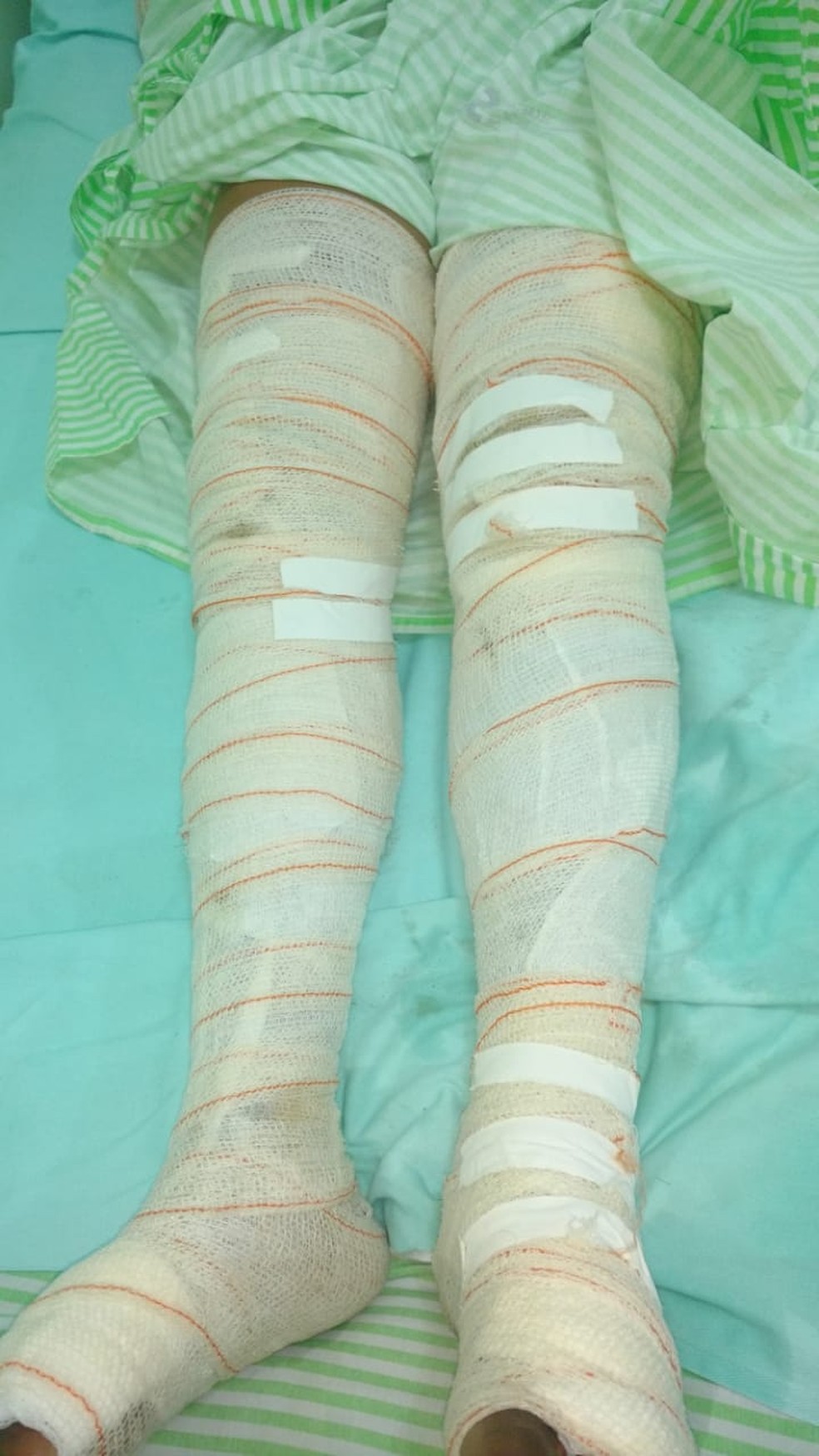Mulher teve braços e pernas queimados e ficou 15 horas sofrendo com a dor dos ferimentos, impedida pelo marido de pedir ajuda. — Foto: Polícia Civil de Água Clara/Divulgação