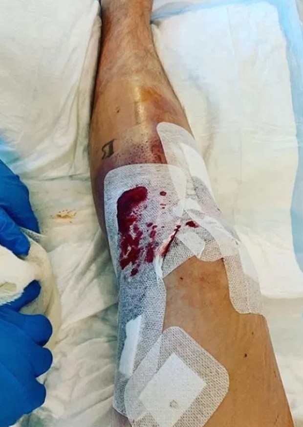 Olly Murs refaz cirurgia no joelho após infecção (Foto: Reprodução/Instagram)