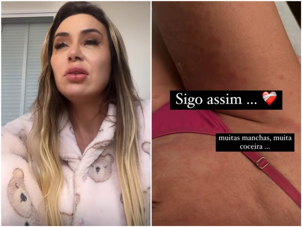Letícia Santiago mostra manchas em 2 de junho (Foto: Reprodução/Instagram)