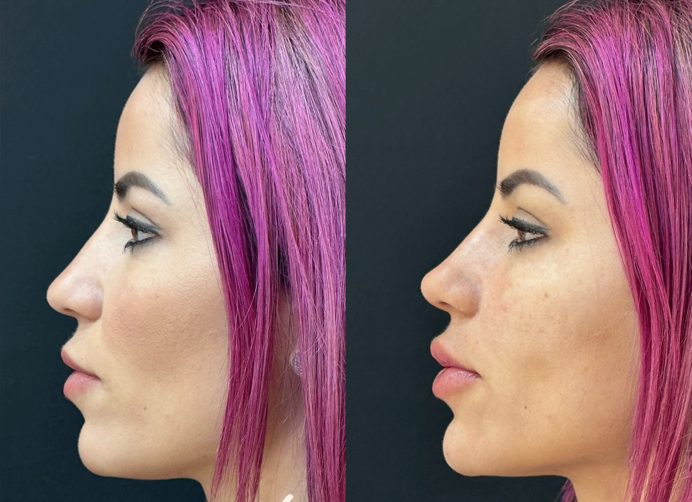 Leticia Bufoni antes e depois da harmonização facial — Foto: Divulgação