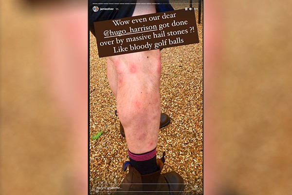 Jamie Oliver mostra os hematomas na perna de um membro de sua equipe causados pela chuva de granizo (Foto: reprodução instagram)