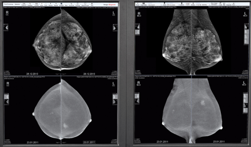 Mamografia (Foto: GE)