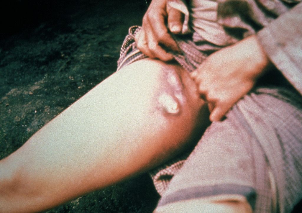 Bubões são sintomas da peste bubônica (Foto: Wikimedia Commons)