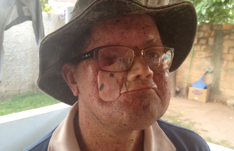 Governo Autoriza Retomada De Repasses Para Tratar Portadores De Doenca Rara De Pele Em Goias Goias G1