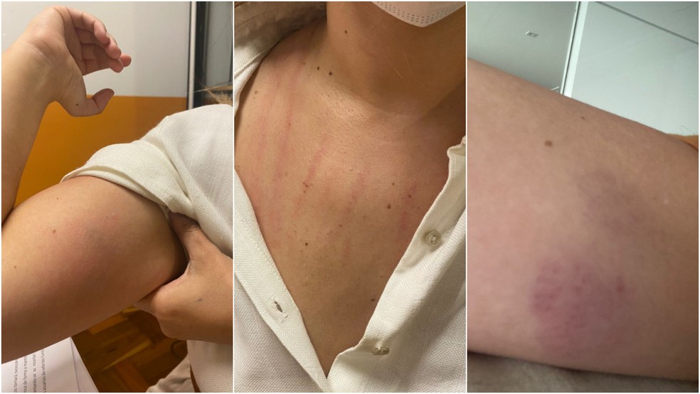 Marcas da agressão que a vereadora Janaína Lima (Novo) diz ter sofrido da vereadora Cris Monteiro, do mesmo partido. — Foto: Divulgação