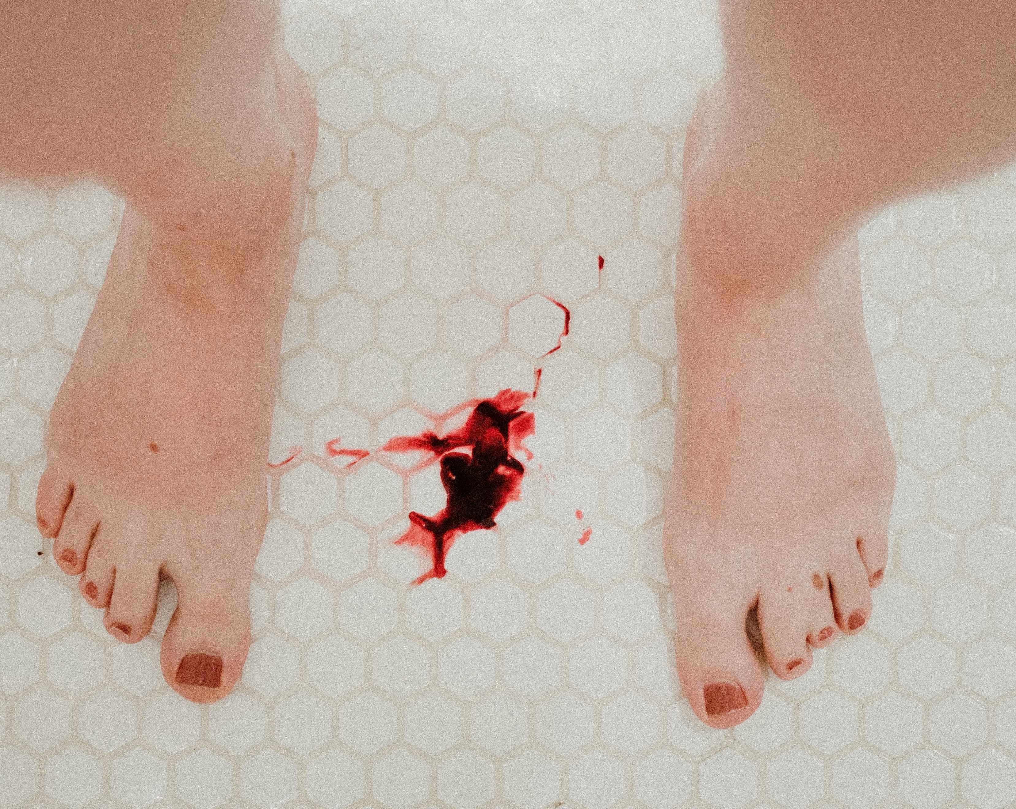 O que é a menorragia, condição que faz sangrar além do normal na menstruação  — e como tratá-la - BBC News Brasil