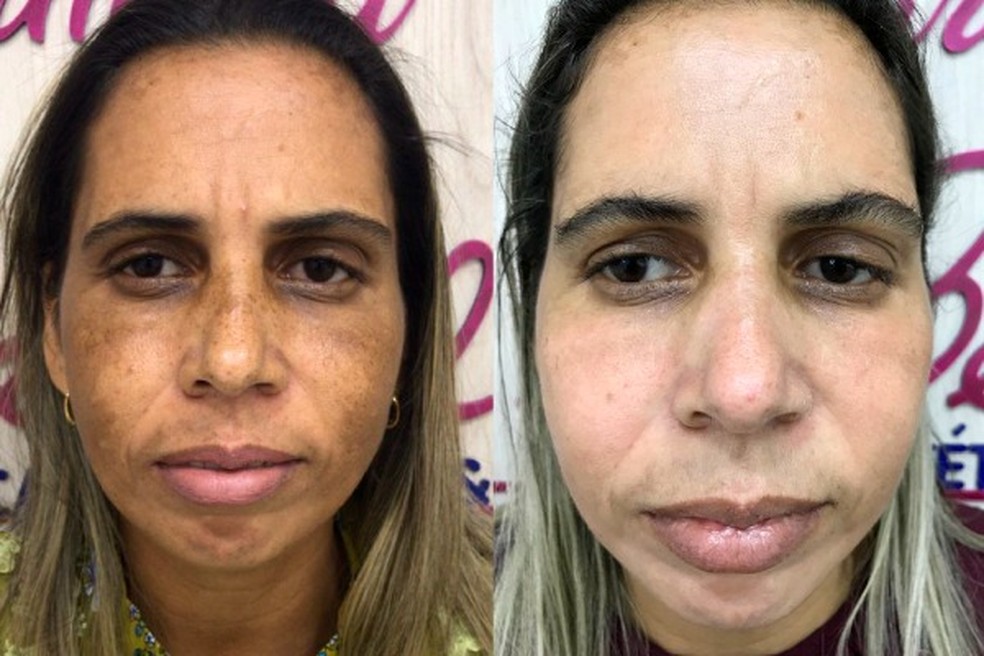 Capixaba desenvolve tratamento inovador contra melasma | Especial  Publicitário - Cimara La Belle | G1