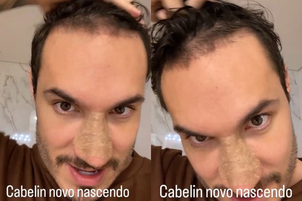 Eliezer mostra resultado de transplante capilar (Foto: Reprodução / Instagram)