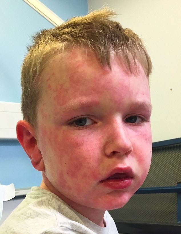 Tommy durante uma reação alérgica (Foto: Caters News Agency)