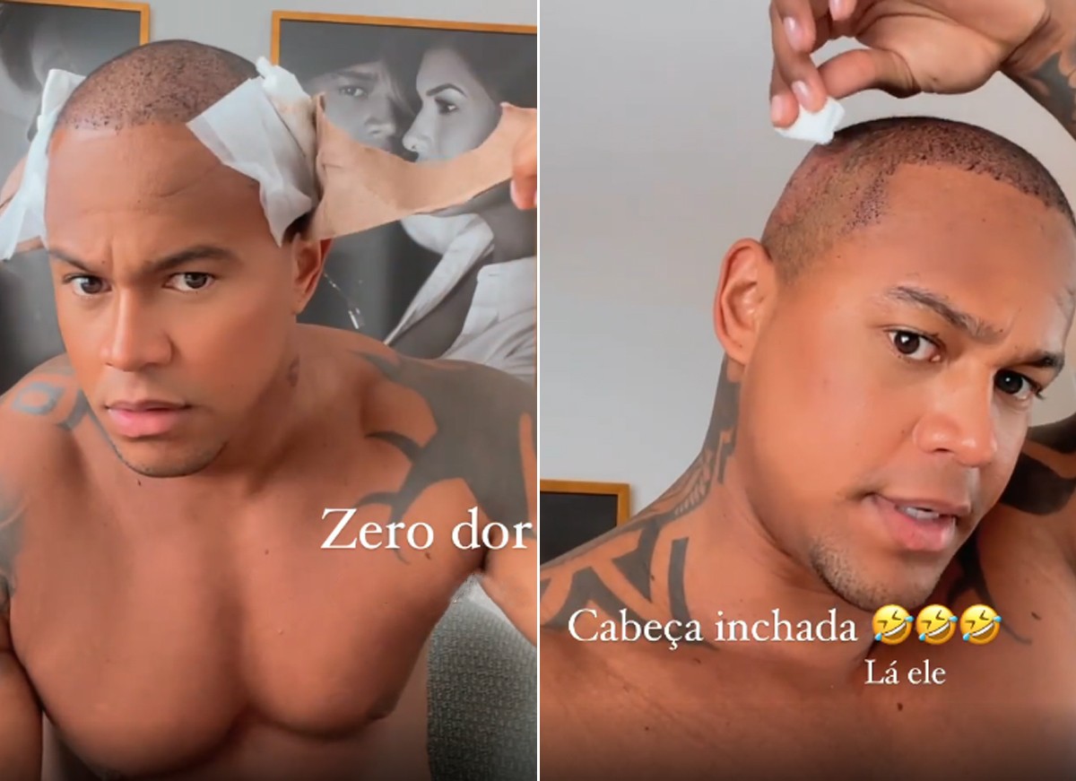 Leo Santana se submete a novo implante capilar: Cabeça está inchada