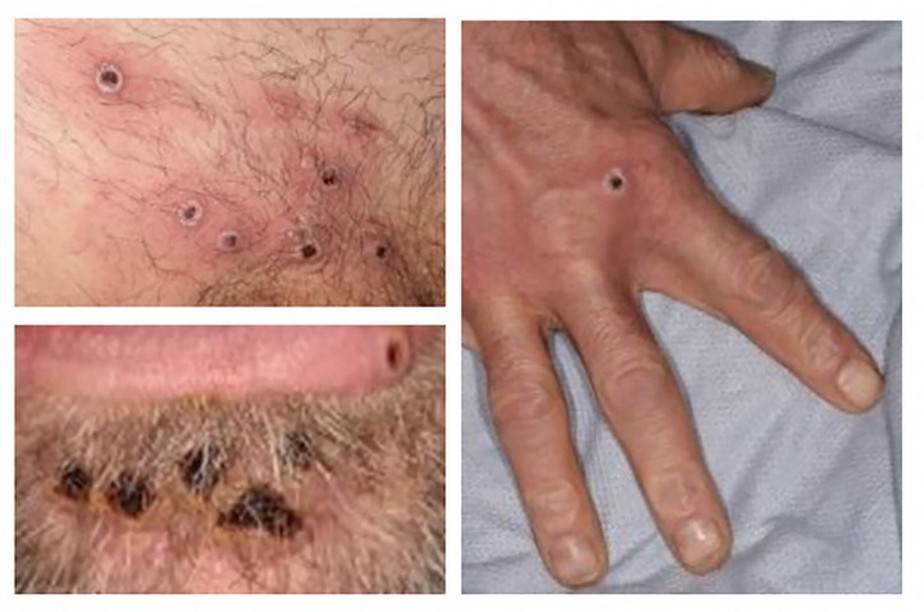 Lesões na pele de paciente diagnosticado com Varíola dos macacos