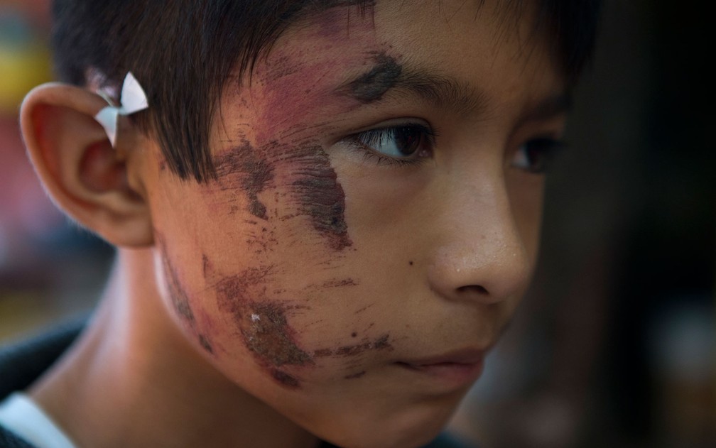 Josué Tolentino Gomez, de 11 anos, exibe ferimentos no rosto após ficar uma hora preso sob escombros depois do terremoto de quinta-feira em Juchitan, no México, no domingo (10) (Foto: AP Photo/Rebecca Blackwell)