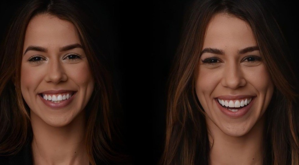 Antes e depois dos dentes de Larissa Tomásia (Foto: Reprodução/Instagram)