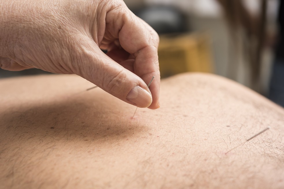 Acupuntura é Bom Para Hernia De Disco Tecnica Milenar Da Acupuntura Traz Beneficios Para Corpo E Mente