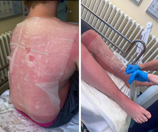 Rian, 15, sofreu queimaduras, principalmente, nas costas e pernas (Foto: Reprodução/Daily Mail)