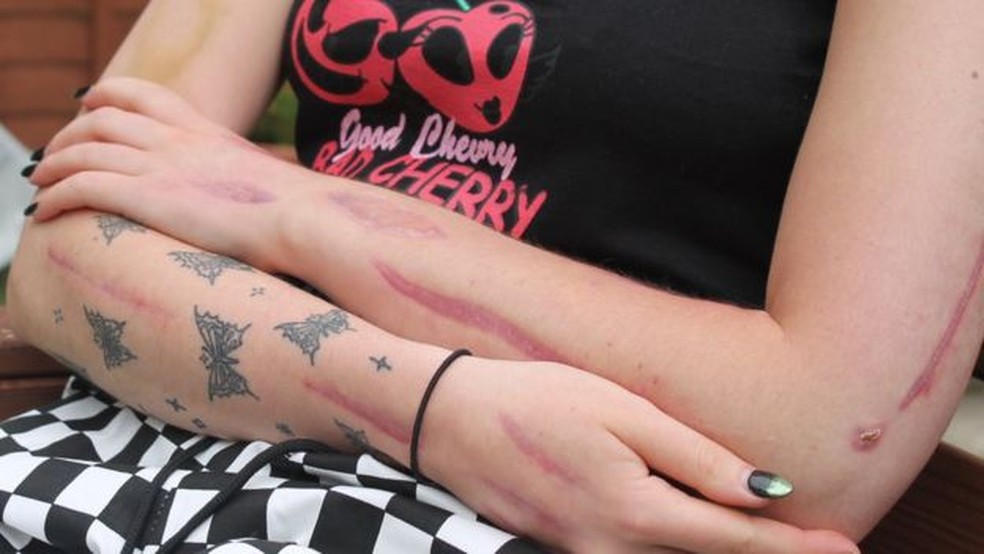 Charlotte afirma que não odeia as suas cicatrizes e até fez borboletas em meio a elas — Foto: BBC