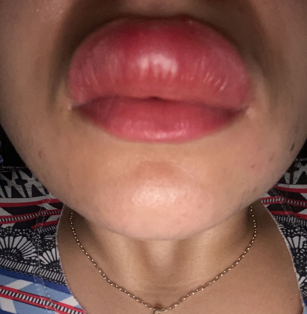 Boca de jovem ficou inchada e ela ainda está tomando medicação em casa — Foto: Arquivo Pessoal