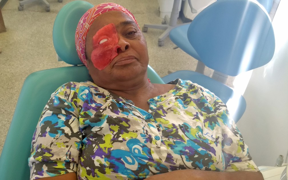 Após remoção de área acometida por tumor, Rosilene Silva testa prótese facial de silicone. (Foto: Marília Marques/G1)