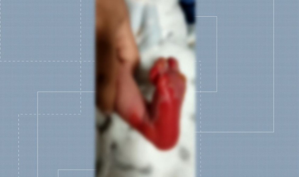 Pé direito do bebê ficou com queimaduras após teste do pezinho, em Curitiba — Foto: Arquivo pessoal
