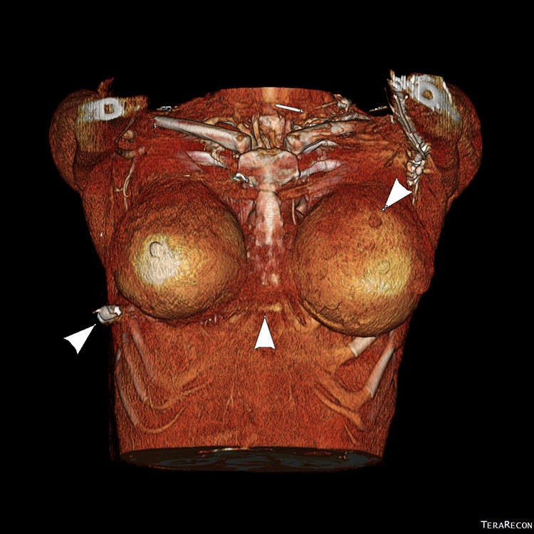Imagem de tomografia computadorizada feita pelos médicos (Foto: Plastic Surgery Case Studies)