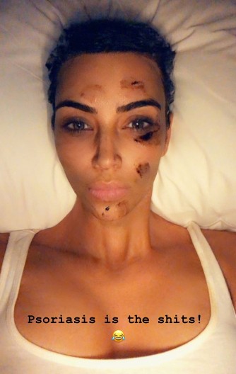 Após receber críticas de internautas sobre o aspecto de sua pele, Kim Kardashian revelou sofrer de psoríase desde os oito anos de idade (Foto: reprodução Instagram )