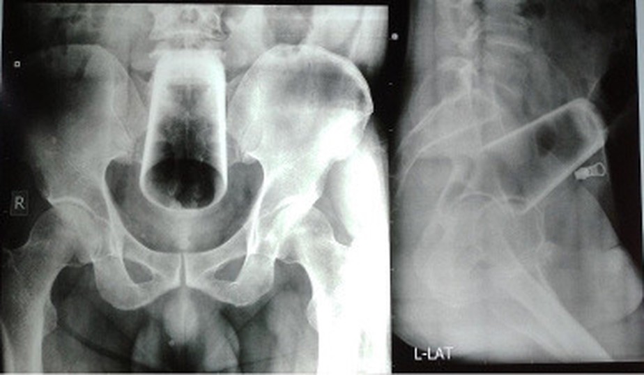 Raio-X do copo de vidro inserido no intestino de um homem nepalês de 47 anos. Foto: Reprodução/Journal of the Nepal Medical Association