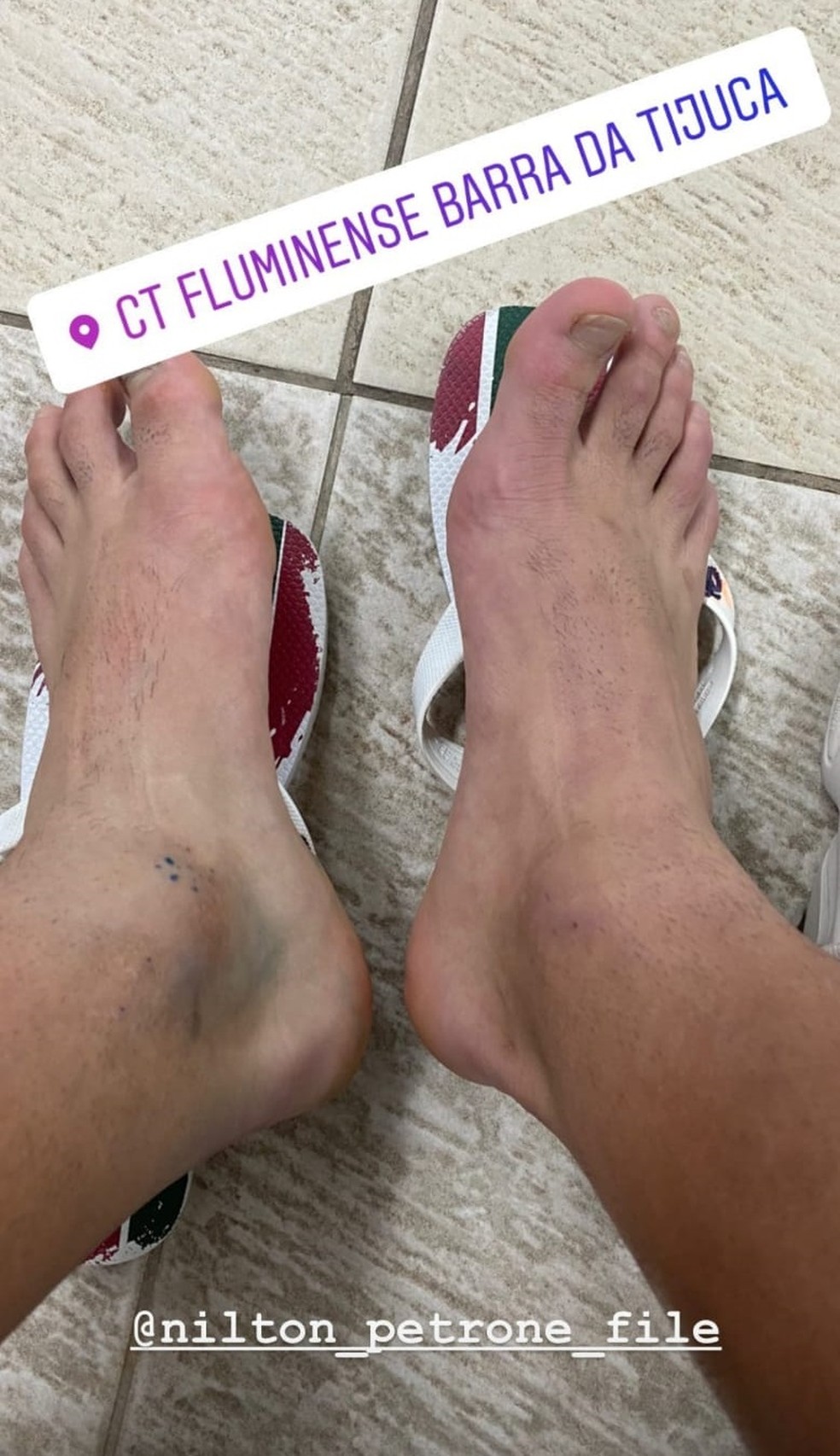 Yago, do Fluminense, posta foto de tornozelo inchado — Foto: Reprodução