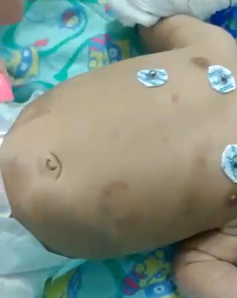 Além de fraturas na costela e afundamento do crânio, bebê de 2 meses também chegou ao hospital de São Fidélis, RJ, com marcas de mordida e hematomas — Foto: Reprodução