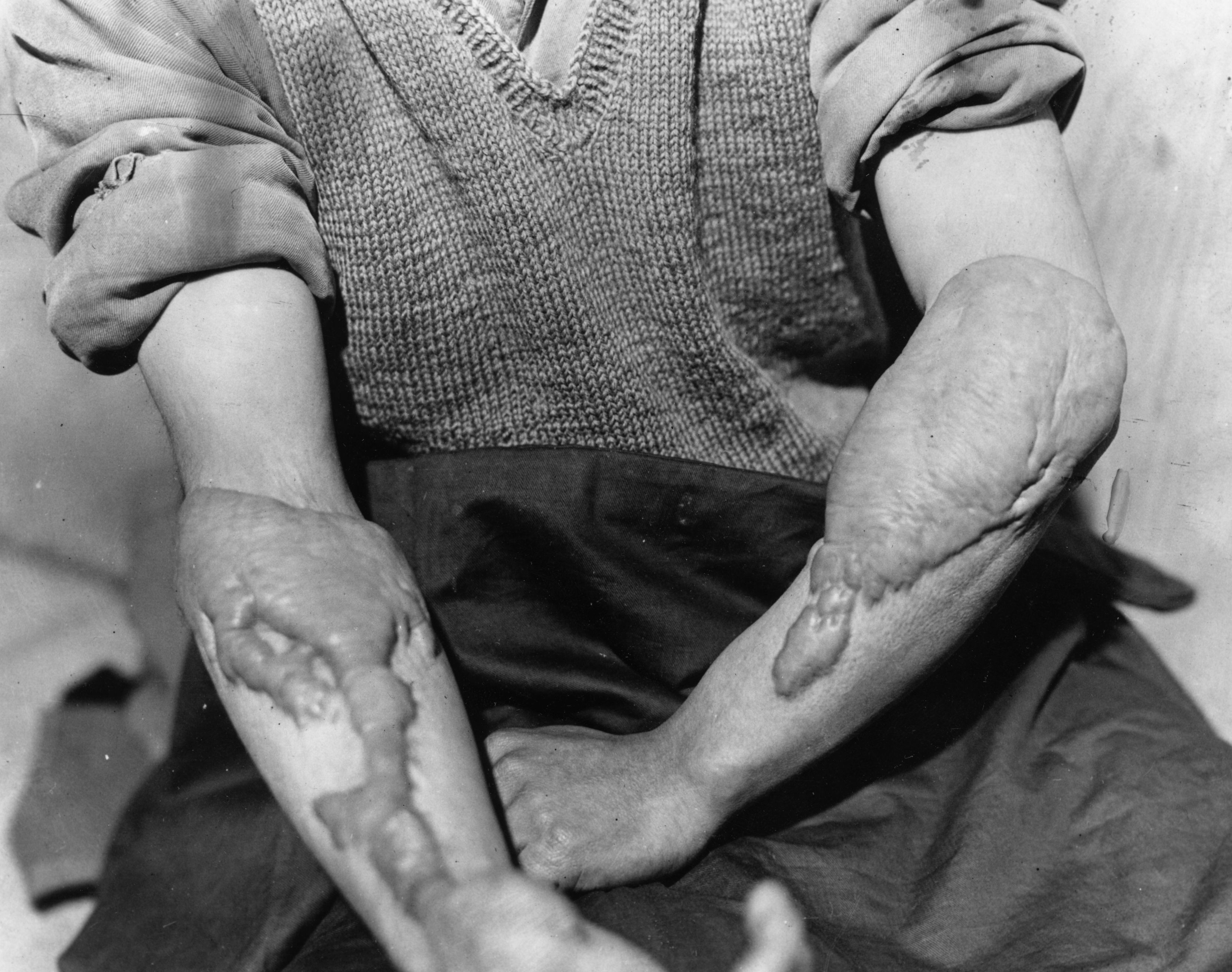 Homem vítima da bomba de Hiroshima com os braços queimados. (Foto: Keystone/Getty Images)